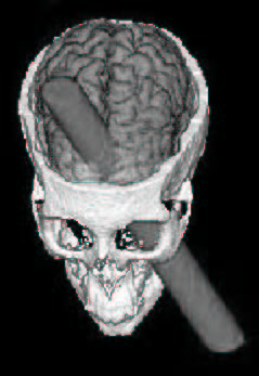Phineas_Gage_CGI.jpg